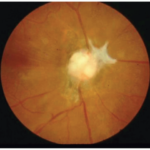 Traumatic optic neuropathy: optic disc swelling and hemorrhage after head trauma
