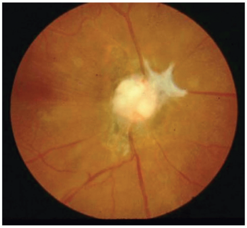 Traumatic Optic Neuropathy Disc Swelling Hemorrhage Traumatic optic neuropathy: optic disc swelling and hemorrhage after head trauma