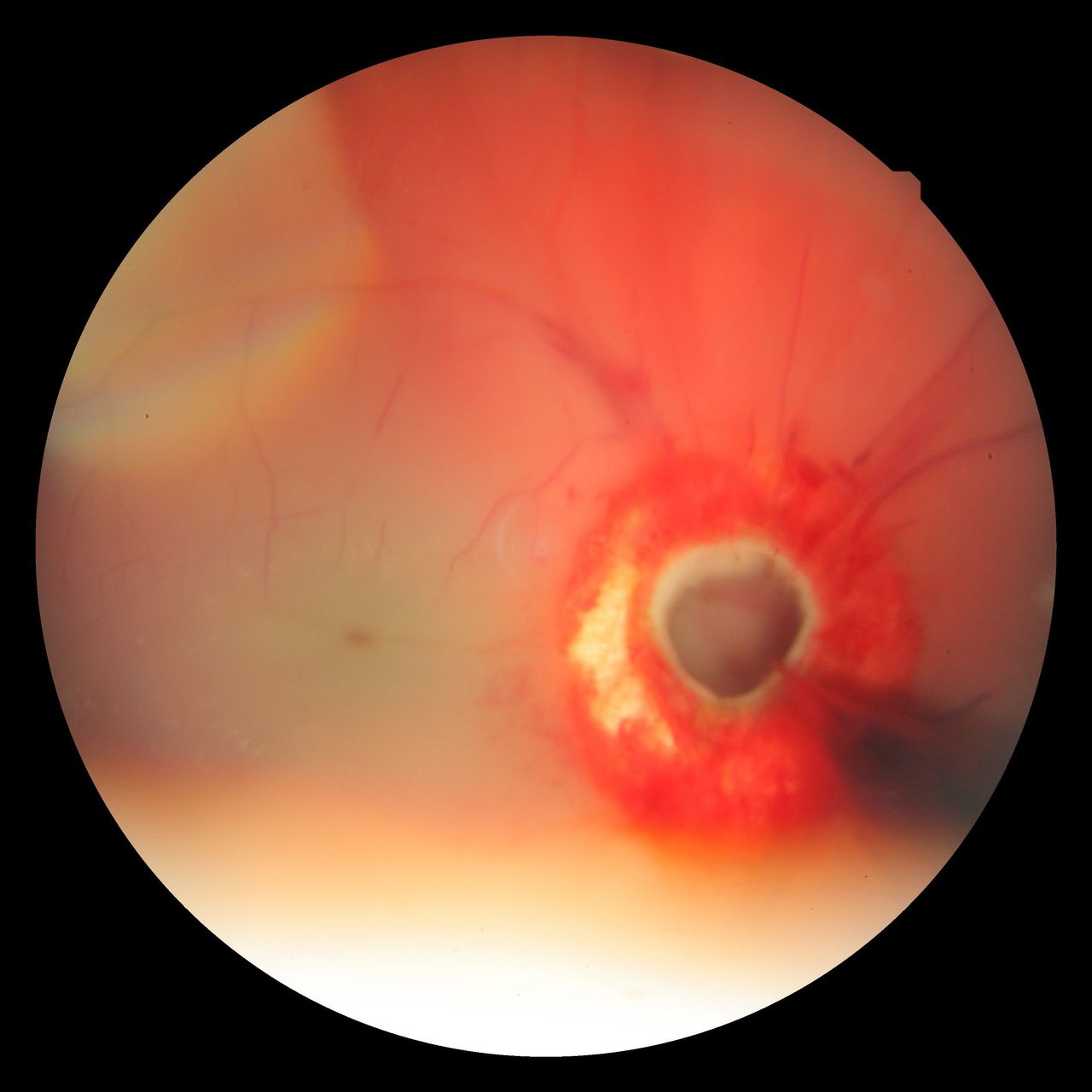 Traumatic Optic Neuropathy Nerve Avulsion Traumatic optic neuropathy: severe optic nerve injury with a central defect consistent with optic nerve avulsion