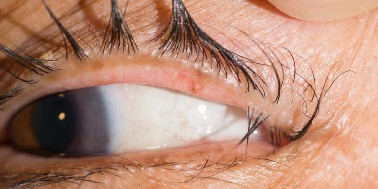 Trichiasis: When the Lid Is Normal but the Lashes Are Not