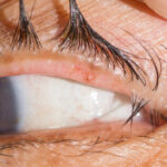 Trichiasis: misdirected eyelashes contacting the ocular surface