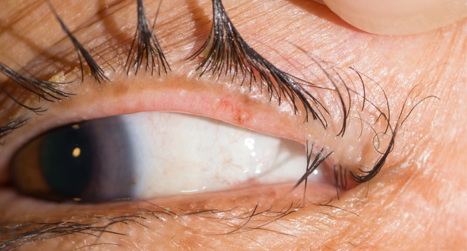 Trichiasis: misdirected eyelashes contacting the ocular surface