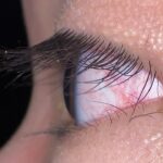 Trichomegaly: abnormally long eyelashes seen on lateral view of the eye