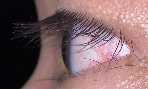 Trichomegaly: When Long Lashes Are a Clinical Sign