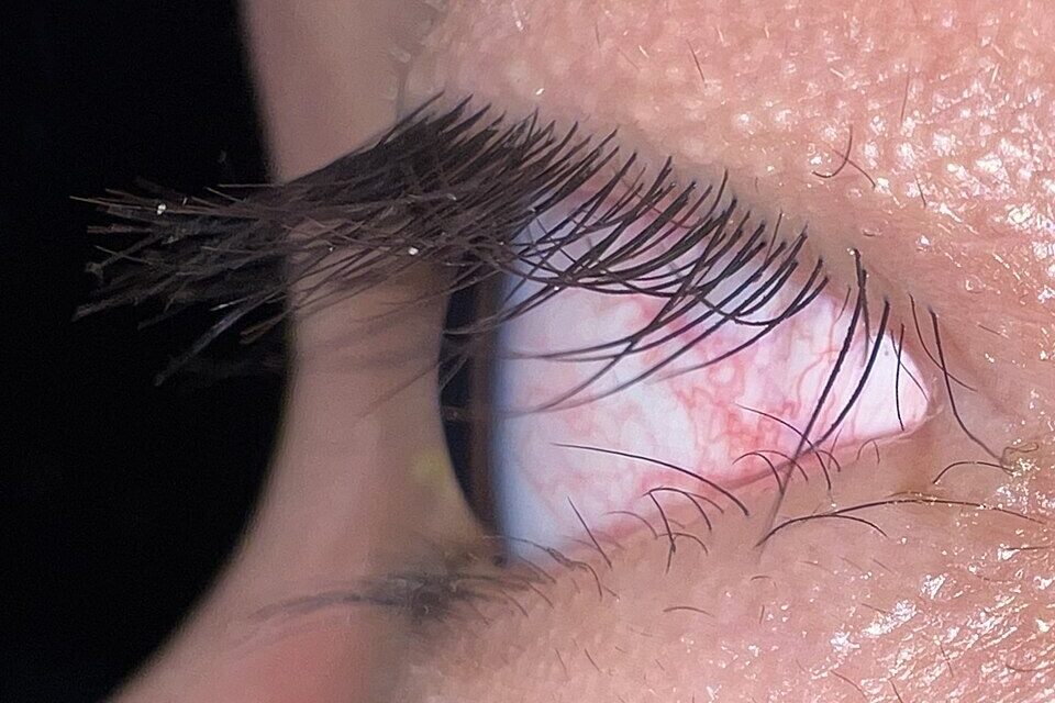 Trichomegaly: When Long Lashes Are a Clinical Sign