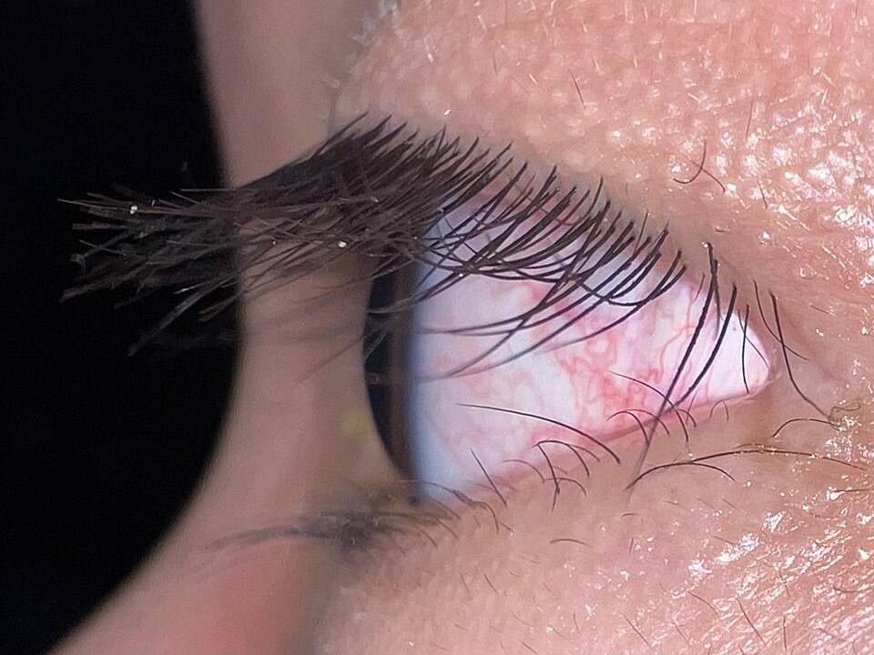 Trichomegaly: abnormally long eyelashes seen on lateral view of the eye