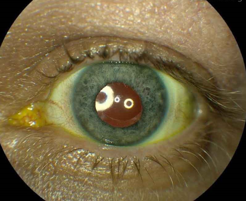 UGH syndrome: layered hyphema in the inferior anterior chamber
