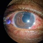 UGH syndrome: a sulcus-fixated intraocular lens with a visible optic edge and mild anterior chamber inflammation
