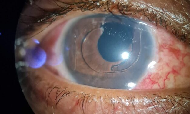 UGH Syndrome: One Malpositioned Lens, Three Diagnoses
