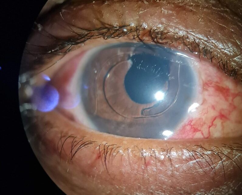 UGH Syndrome: One Malpositioned Lens, Three Diagnoses