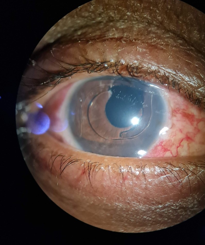 UGH syndrome: a sulcus-fixated intraocular lens with a visible optic edge and mild anterior chamber inflammation