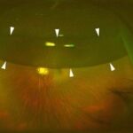 Ultra-widefield retinal imaging: ultra-widefield image of an eye with a superior bullous retinal detachment (arrowheads)