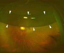 Ultra-Widefield Retinal Imaging: What the Extra Field Adds and Where It Misleads