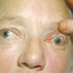 Unilateral proptosis with globe displacement, requiring evaluation for orbital and systemic causes