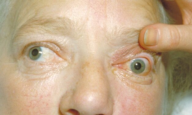 Proptosis: Building the Differential Beyond Thyroid Eye Disease