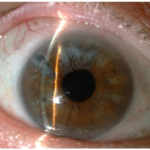 Clinical eye photograph illustrating Uveitic Glaucoma Management Strategies