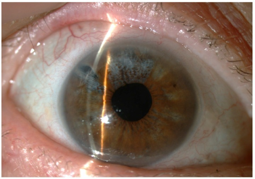 Uveitic Glaucoma: When Two Problems Are Feeding Each Other