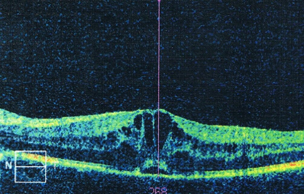 Uveitic Macular Edema: Why Controlling Inflammation Comes Before Treating the Fluid