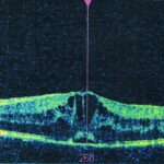 Uveitic macular edema: OCT of the macula showing cystoid spaces and central retinal thickening