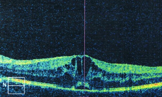 Uveitic Macular Edema: Why Controlling Inflammation Comes Before Treating the Fluid