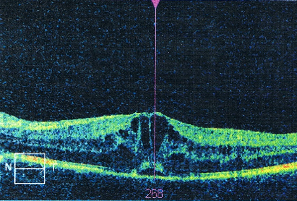 Uveitic macular edema: OCT of the macula showing cystoid spaces and central retinal thickening