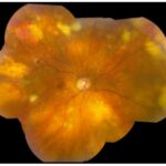 Uveitis masquerade syndromes: fundus photograph montage of primary vitreoretinal lymphoma showing multiple yellowish subretinal lesions