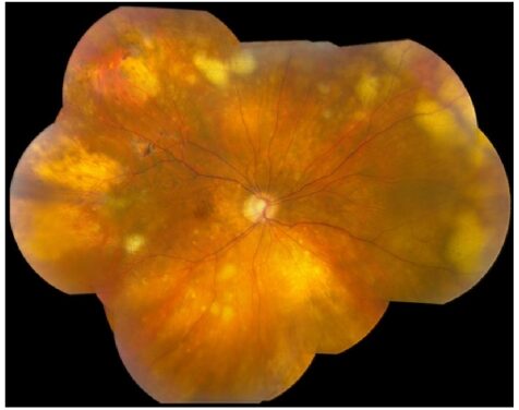 Uveitis Masquerade Syndromes: When Steroid-Resistant Vitritis Is Not Inflammation