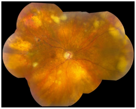 Uveitis Masquerade Syndromes: When Steroid-Resistant Vitritis Is Not Inflammation