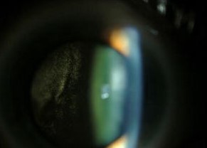 Uveitis masquerade syndromes: slit-lamp photograph of an eye with diffuse large B cell lymphoma cells in the vitreous