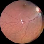 Vigabatrin Retinal Toxicity: clinical photograph