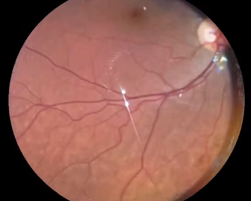Vigabatrin Retinal Toxicity: Peripheral Field Loss That Patients Do Not Notice