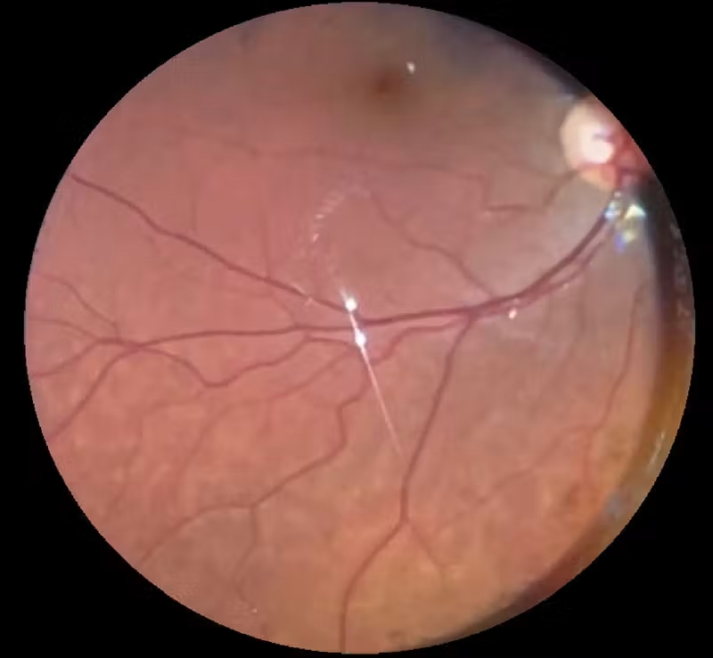 Vigabatrin Retinal Toxicity Clinical Photograph 1 Vigabatrin Retinal Toxicity: clinical photograph