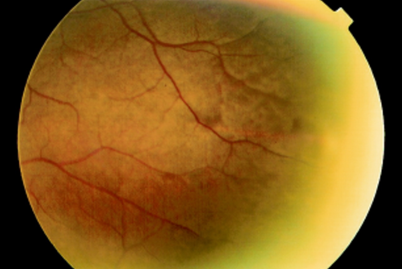 Vigabatrin Retinal Toxicity Clinical Photograph 2 Vigabatrin Retinal Toxicity: fundus photograph, second view