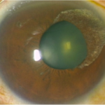 Clinical eye photograph illustrating Viral Anterior Uveitis Cmv Hsv Vzv