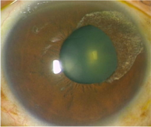 Viral Anterior Uveitis: CMV, HSV, and VZV Behind the Slit Lamp
