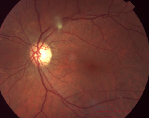 Vitreous amyloidosis: fundus photograph showing vitreous haze overlying the optic disc