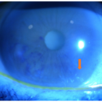 Vitreous amyloidosis: slit-lamp view showing glass-wool-like vitreous opacities (arrow)