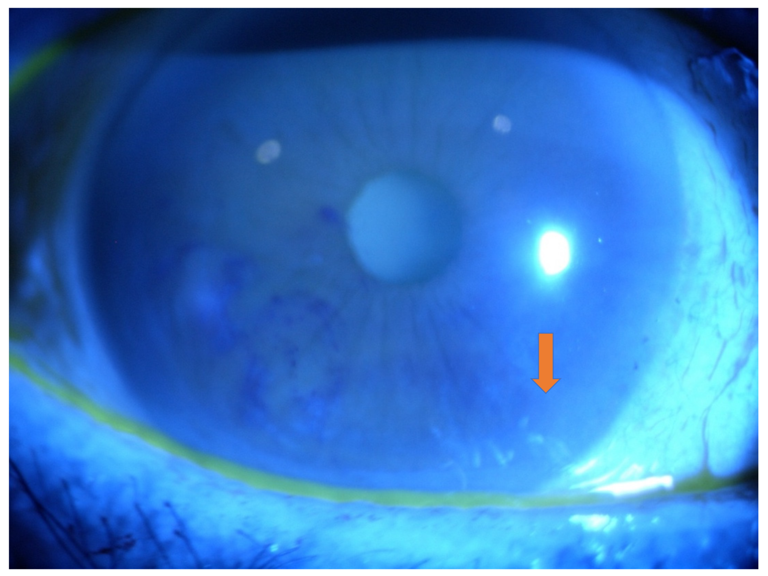 Vitreous Amyloidosis: The Eye Finding That Can Diagnose a Systemic Disease