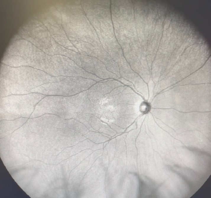 Vitreous floaters: ultra-widefield infrared fundus image of an eye with no floater shadows for comparison
