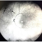 Vitreous floaters: ultra-widefield infrared fundus image showing diffuse shadows cast by vitreous floaters (arrows)