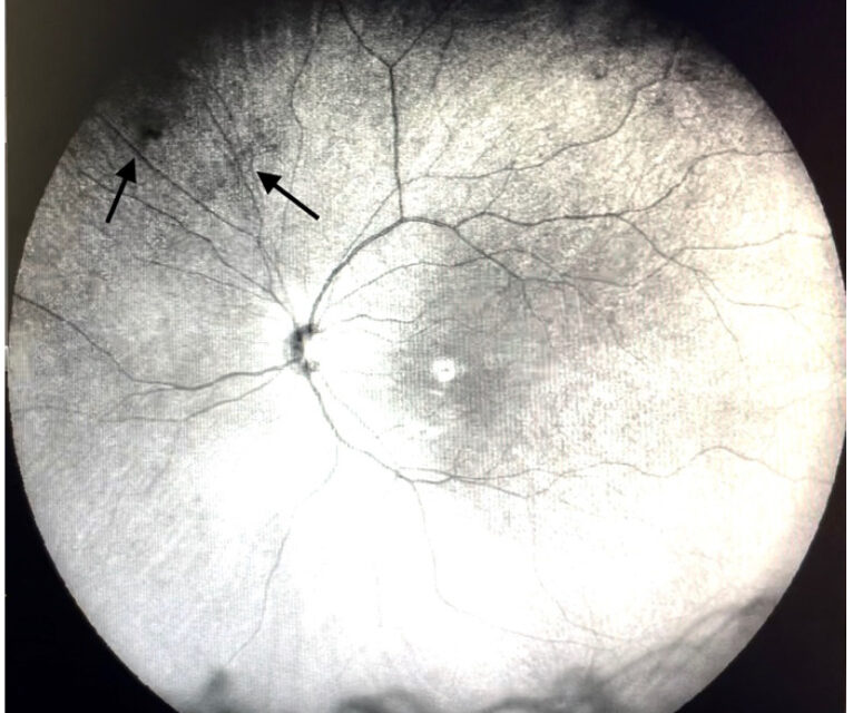 Vitreous Floaters: Who Needs Urgent Examination and Who Needs Reassurance