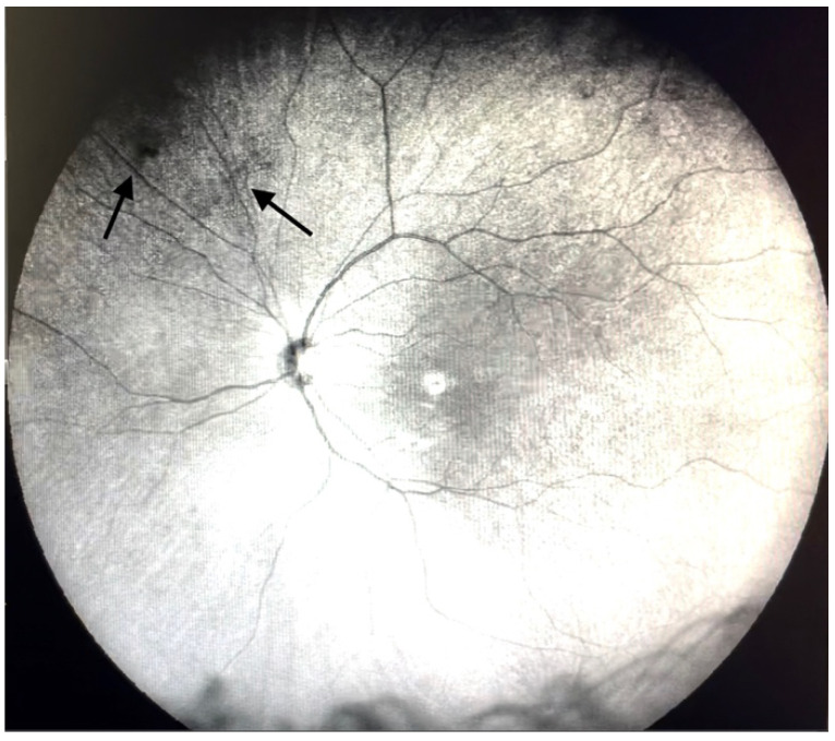 Vitreous floaters: ultra-widefield infrared fundus image showing diffuse shadows cast by vitreous floaters (arrows)