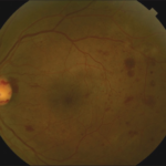 Clinical eye photograph illustrating Vitreous Hemorrhage Diabetic Workup