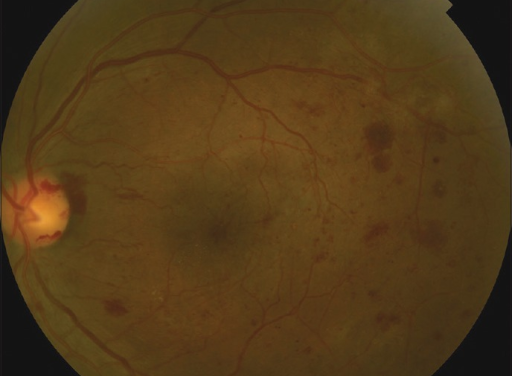 Vitreous Hemorrhage in Diabetes: A Systematic Look Behind the Blood