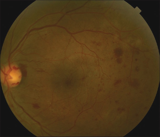Vitreous Hemorrhage in Diabetes: A Systematic Look Behind the Blood