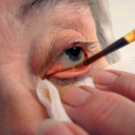 Clinical eye photograph illustrating Vitreous Loss Cataract Surgery Management