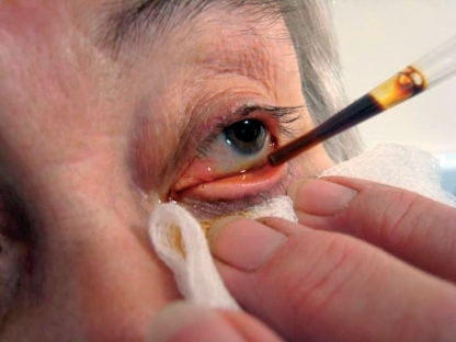 Vitreous Loss During Cataract Surgery: Recognizing and Managing a Break in the Posterior Capsule