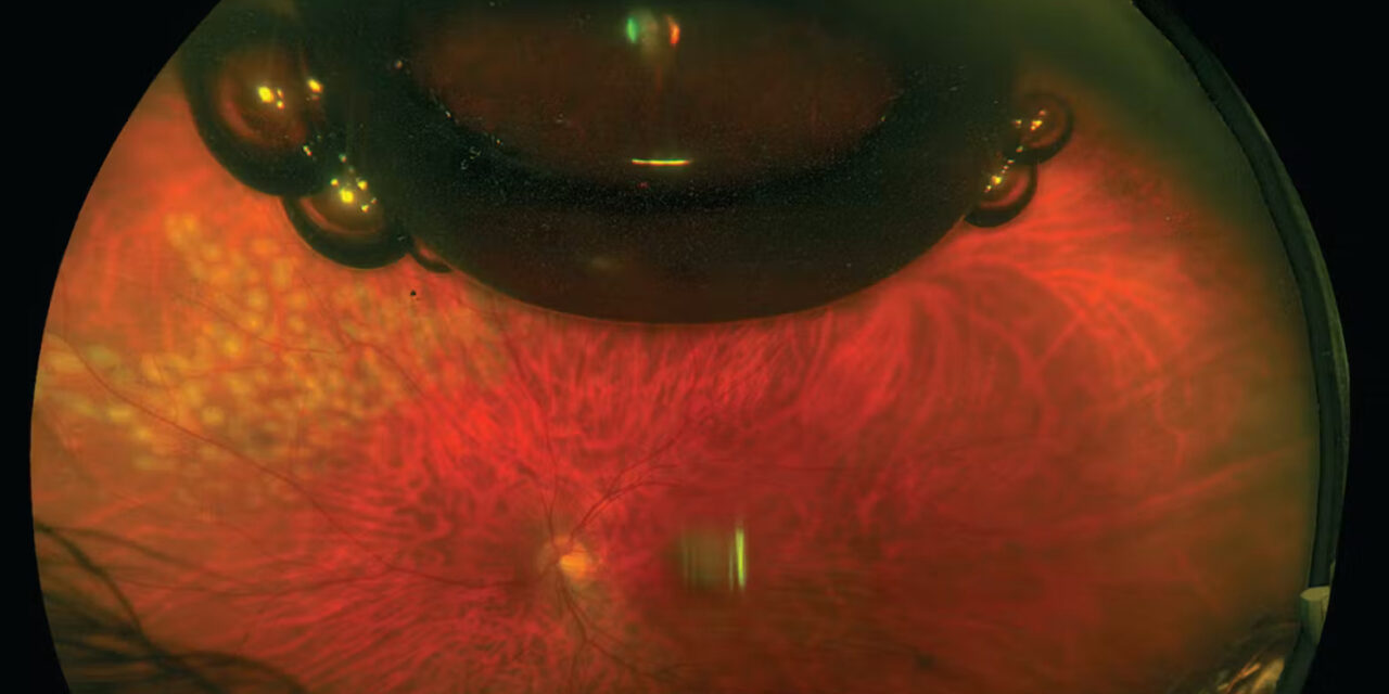 Vitreous Substitutes: Choosing the Right Tamponade After Vitrectomy