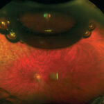 Vitreous substitutes: wide-field fundus view showing an intraocular gas bubble meniscus after vitrectomy