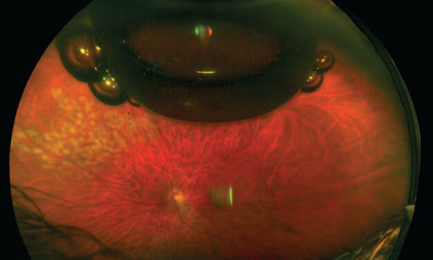 Vitreous Substitutes: Choosing the Right Tamponade After Vitrectomy